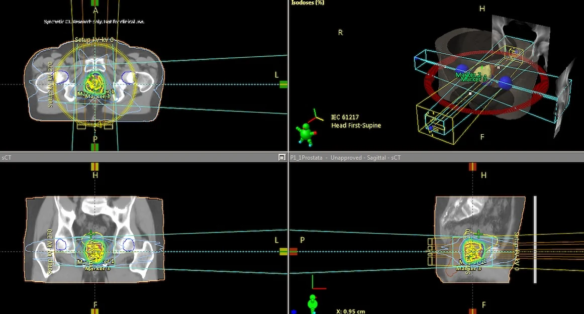 Radiotherapy planning views with synthetic CT images and radiation dose overlays